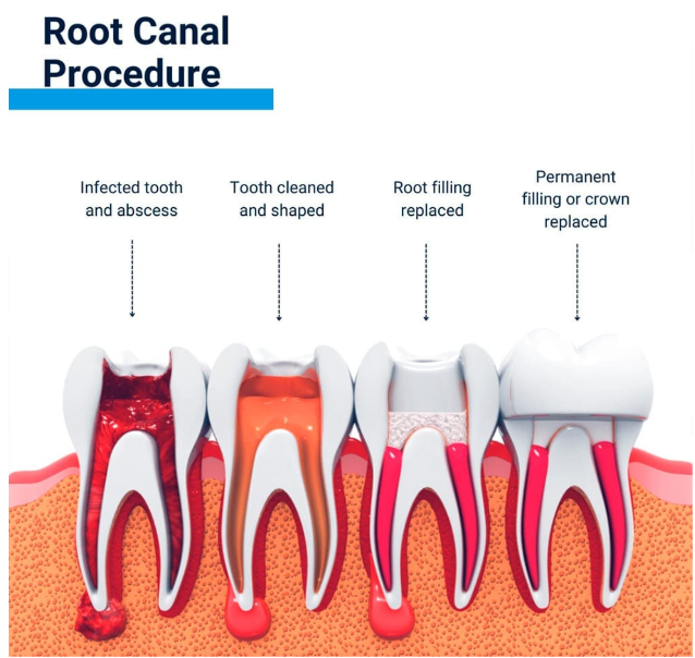 Root Canal Vadodara